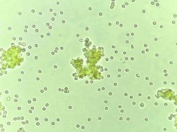 Foto Lichtmikroskop: Agglutination von Blutzellen durch Nahrungslektine. Blutgruppendiät verhindert Agglutination, Thrombosegefahr und chronische Entzündungen. © dadamo.com