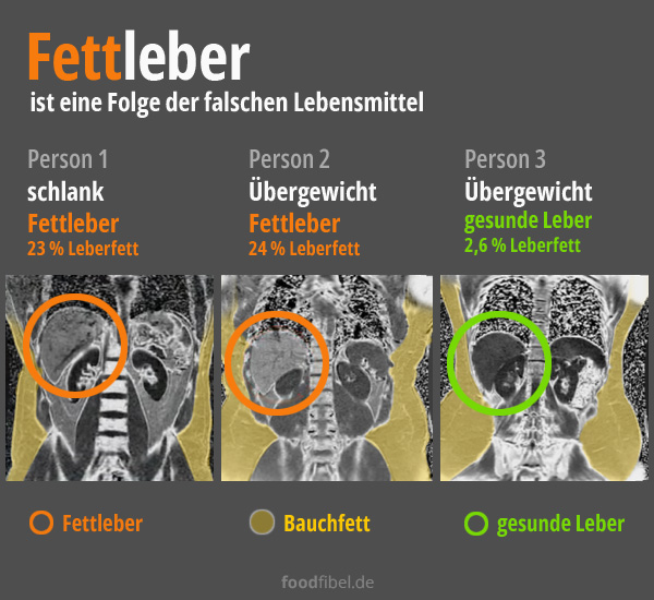 Fettleber als Folge der falschen Lebensmittel. Drei CT-Scans: A-Übergewicht-gesunde Leber. B-Übergewicht-Fettleber. C-Schlank-Fettleber. Quelle: R.H. Lustig, M.D. University of California, San Francisco, 2023. © foodfibel.de